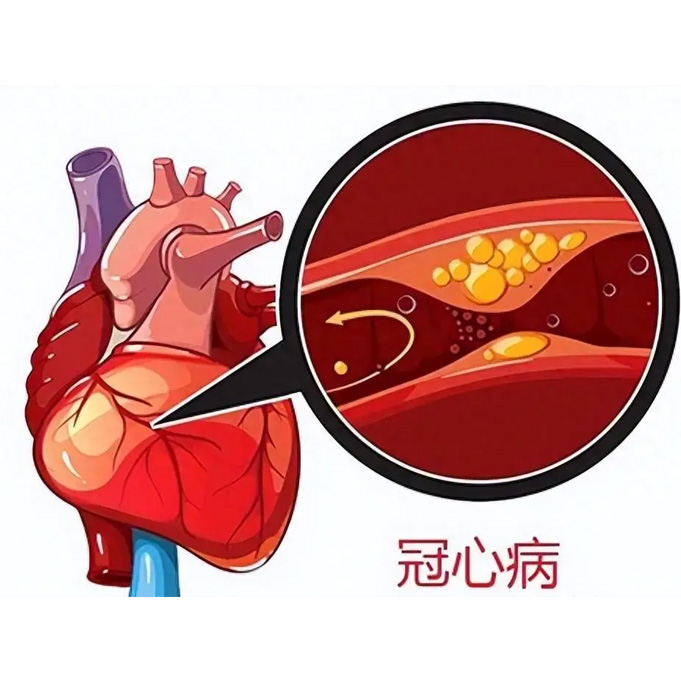 心脑血管疾病及高血压